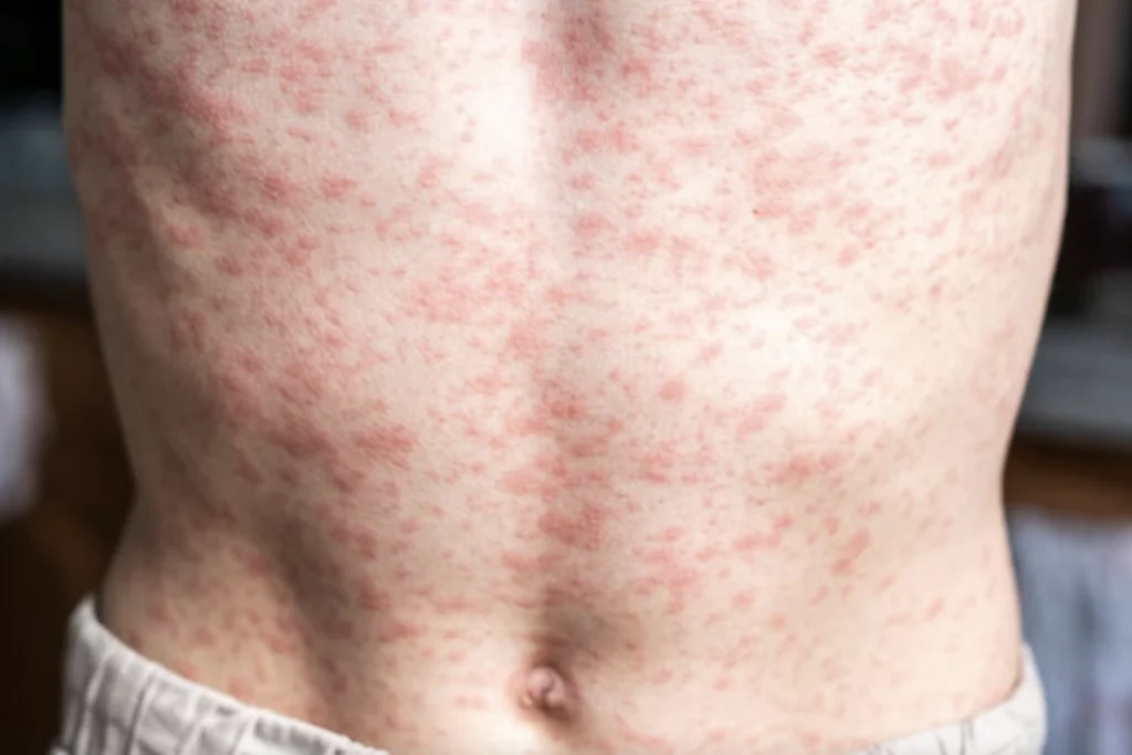 De acuerdo con la Organización Mundial de la Salud (OMS), sigue siendo una de las infecciones virales más contagiosas del mundo.